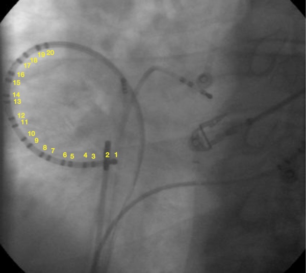 ra ablation for atrial flutter icd 10 pcs